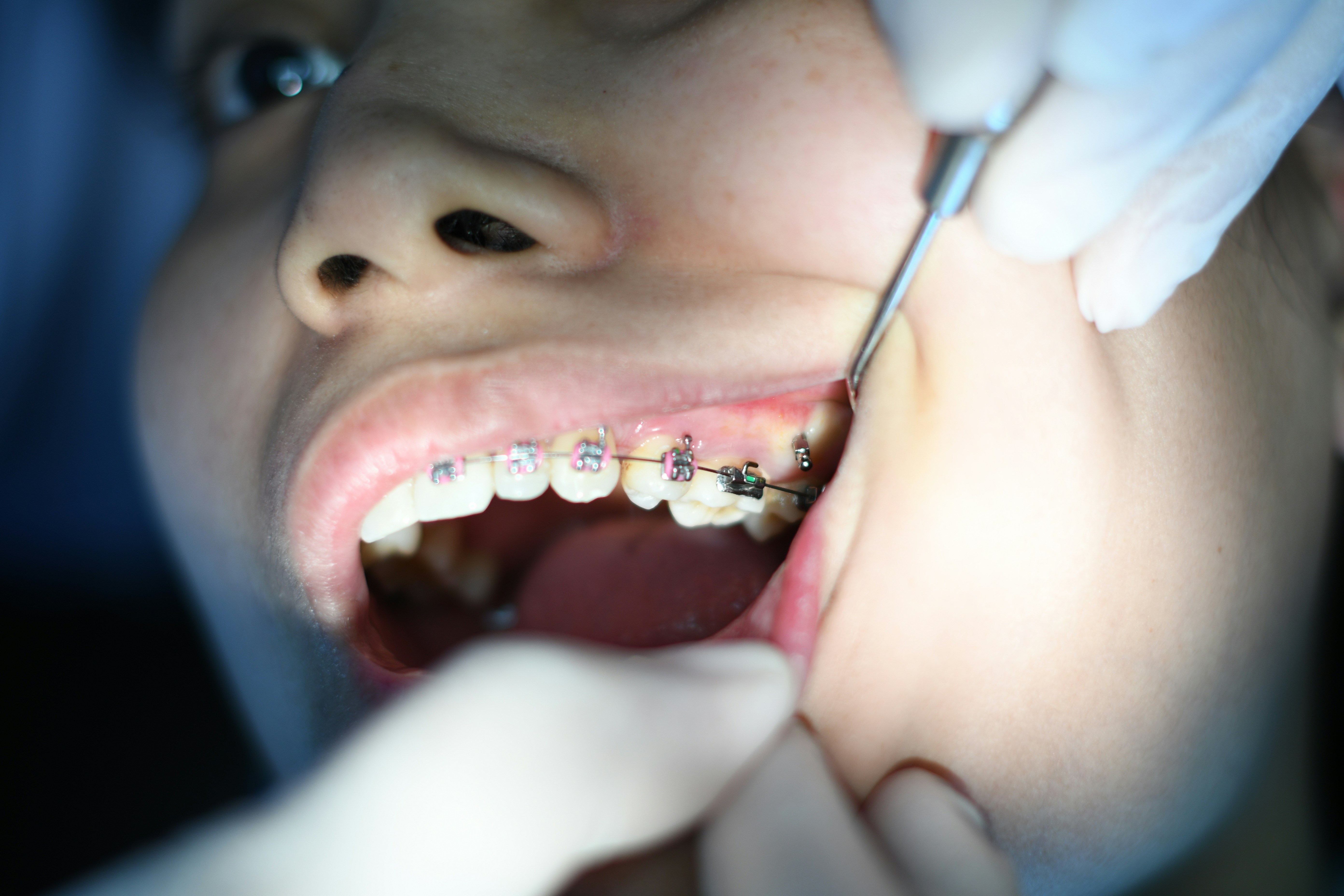 Braces and clear aligners round thumbnail